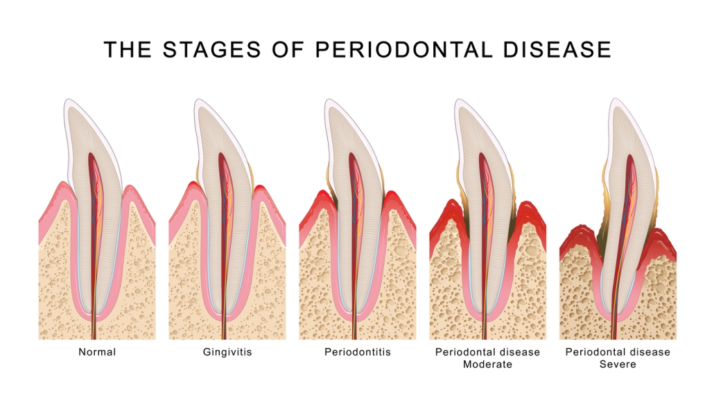 The stages of periodontal disease
