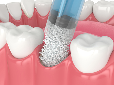 extraction filling