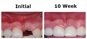 Implant Tooth #9