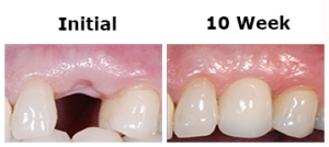 Implant Tooth #11