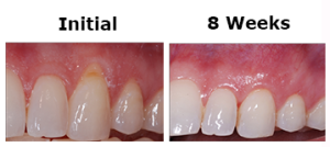 Root Coverage Tooth #11