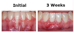 Root Coverage Tooth #25