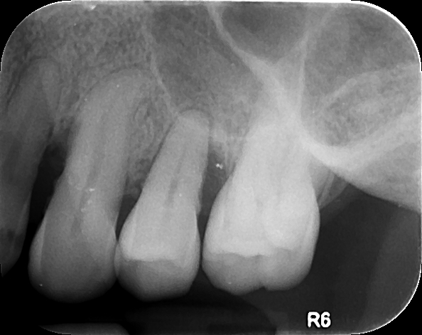 Pre Op 1