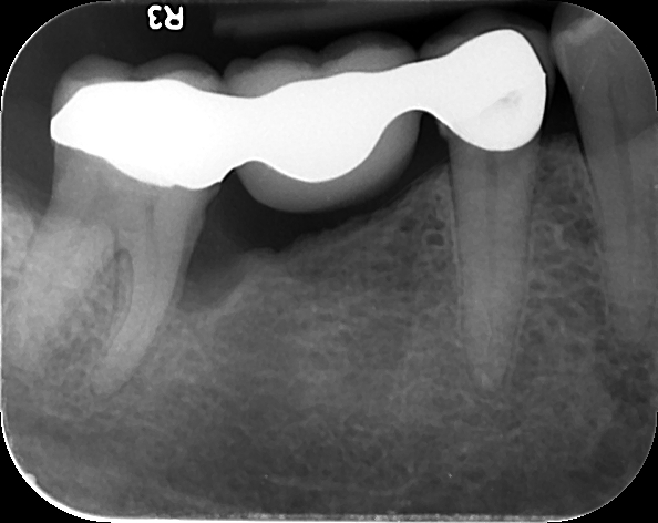 Pre Op 1