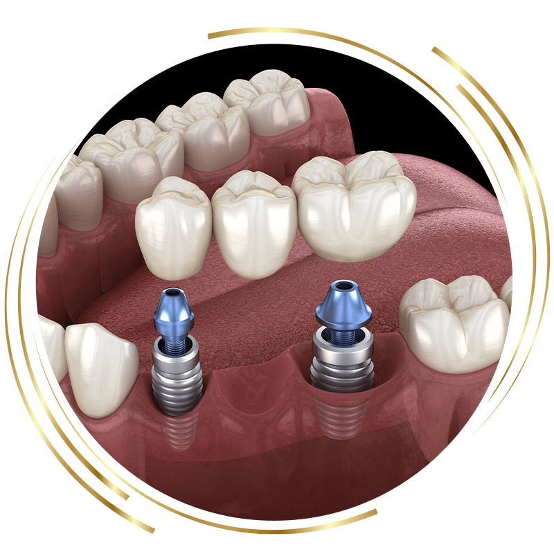 dental bridge 3d