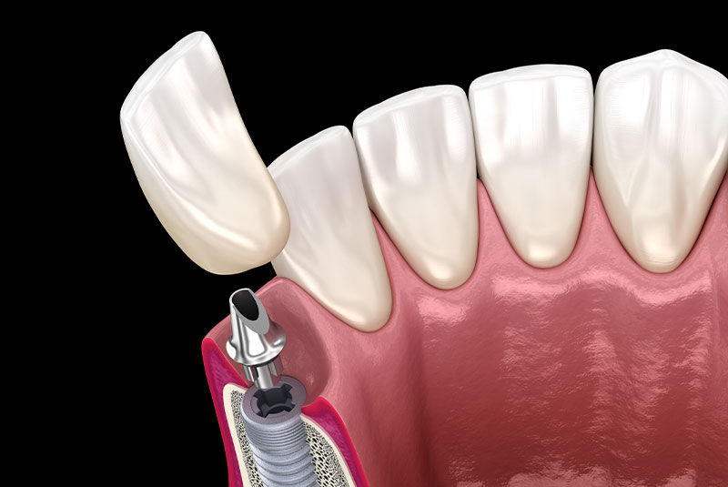 dental implant 5050