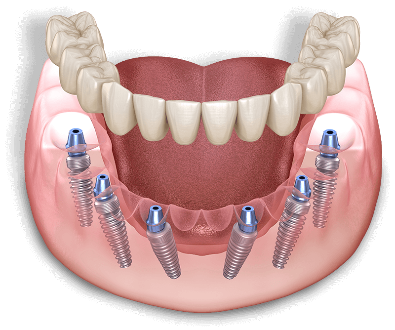 full arch model 3d