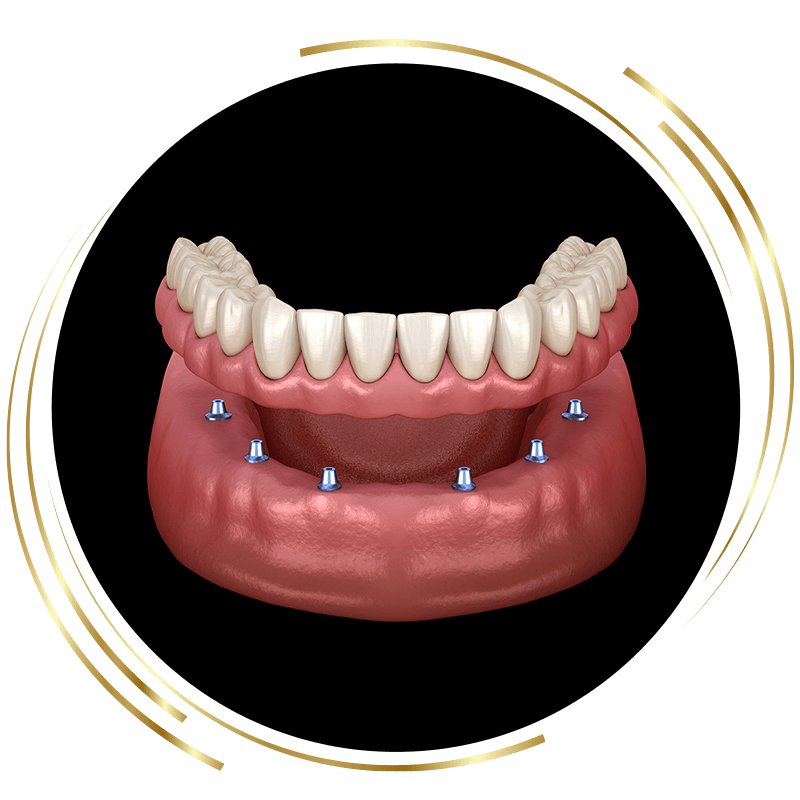 implant supported