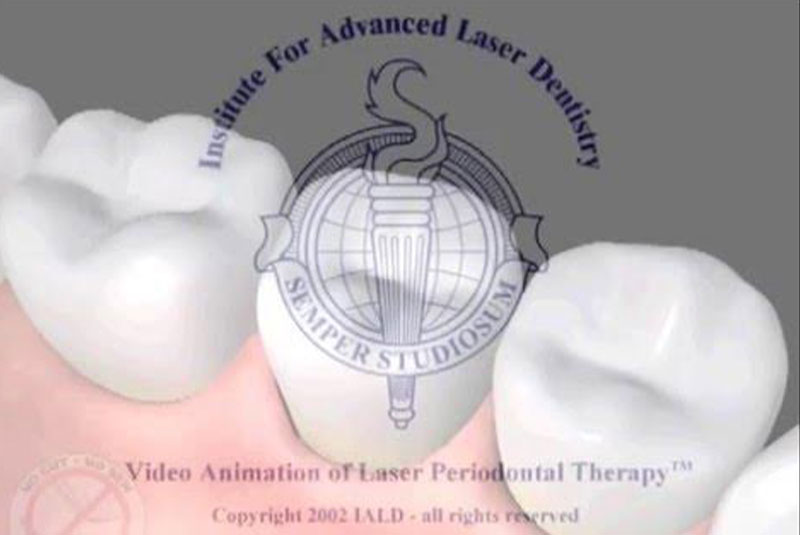 laser advanced