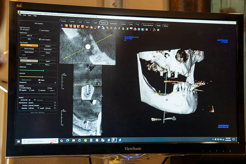 Dental Implant X-ray