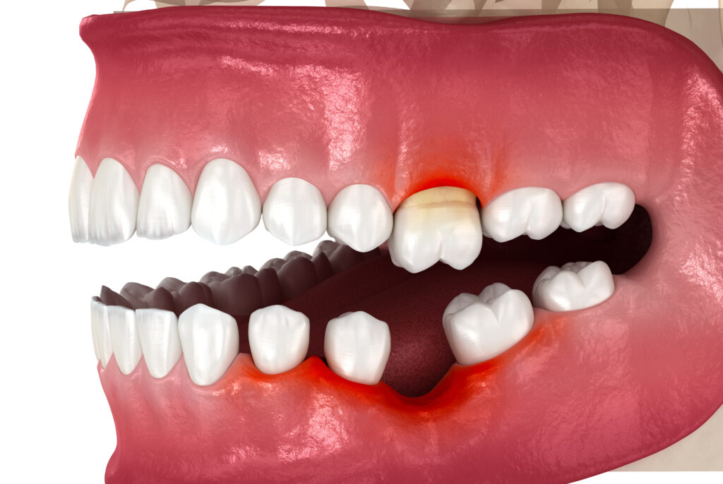 tooth loss