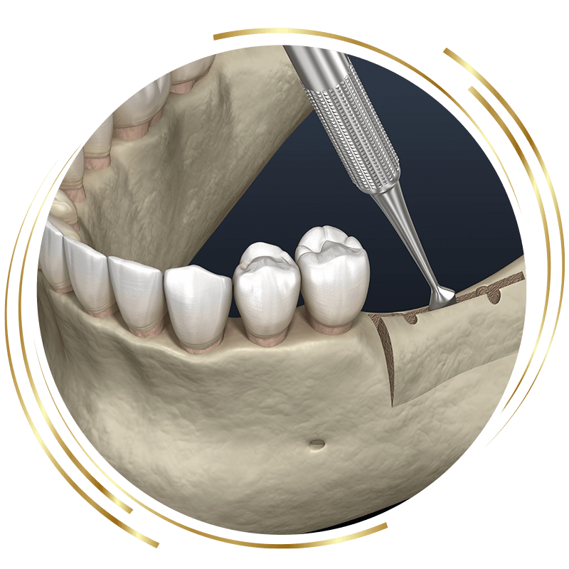 Ridge Augmentation