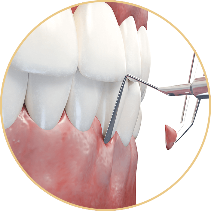 Gum Grafting