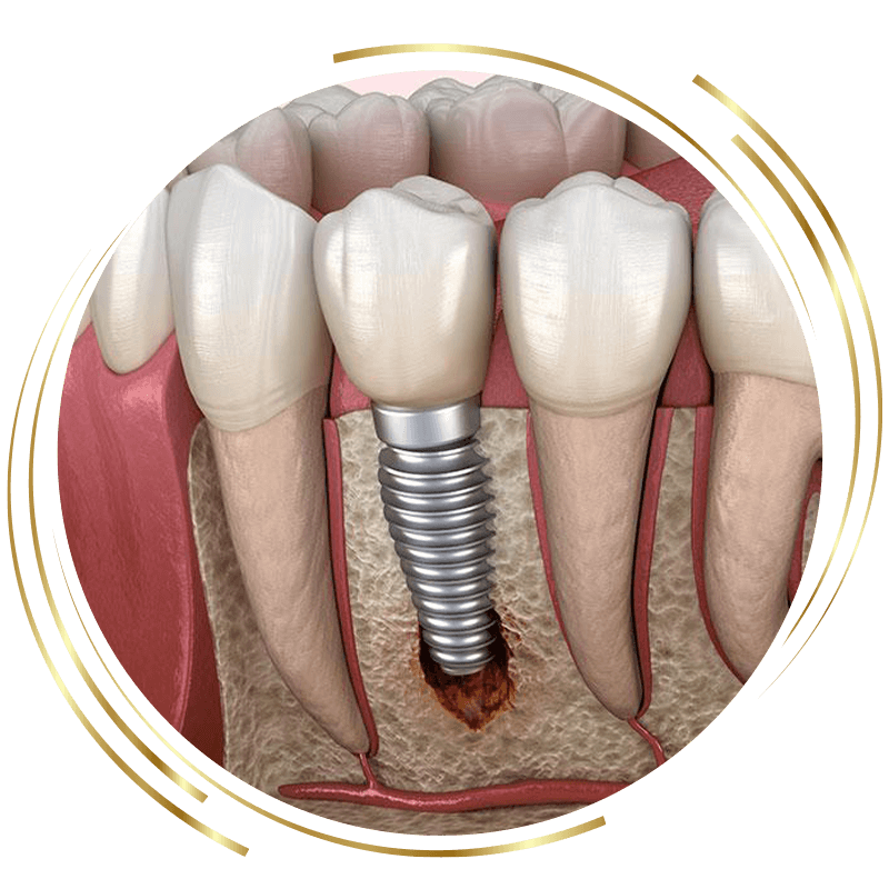 Failing dental implants