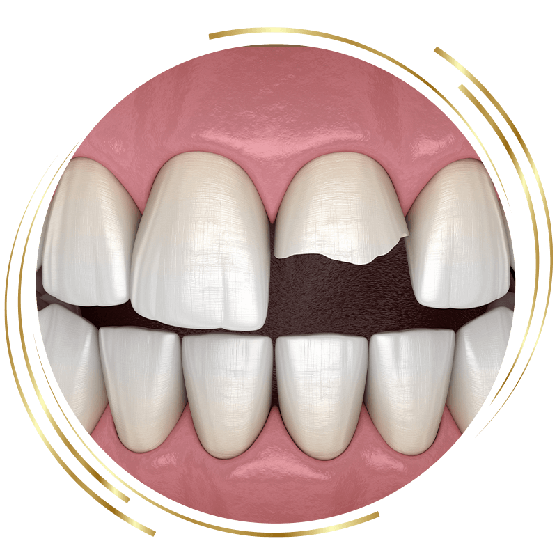 cracked tooth