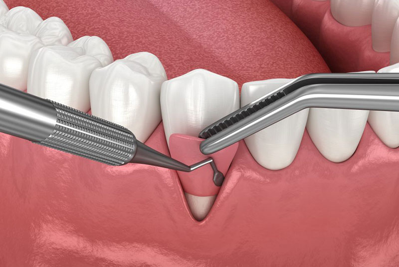 Pinhole Surgical Technique