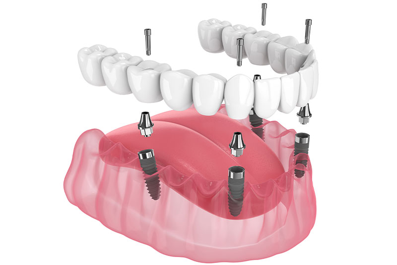 dental implants