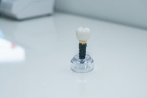 Periodontal specialist explaining dental implants to a patient
