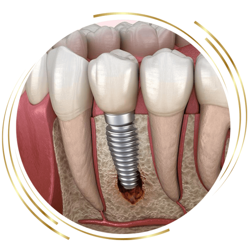 Failing dental implants